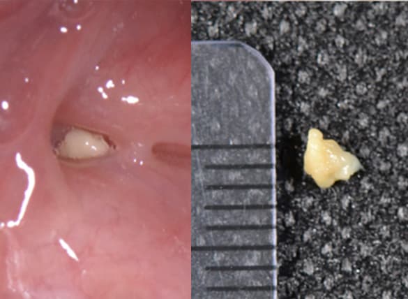 Cáseos Amigdalianos