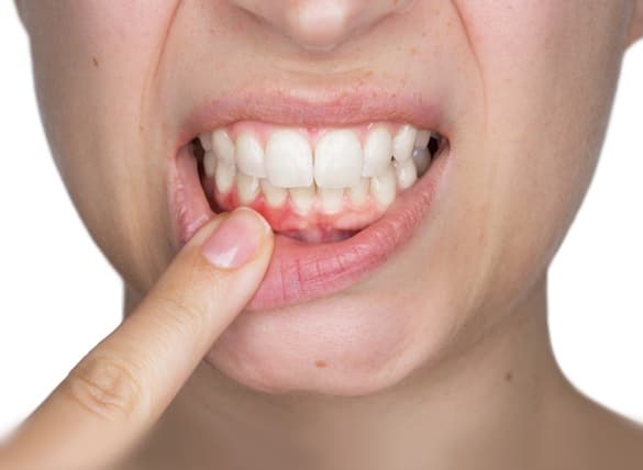 Gengiva inflamada com sinais de gengivite