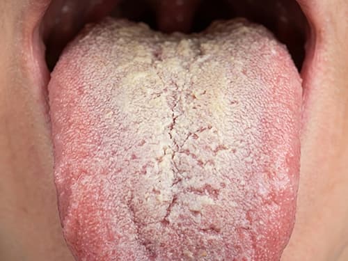 Língua com saburra lingual esbranquiçada