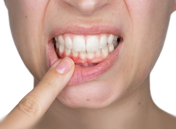 Gengiva inflamada com sinais de gengivite